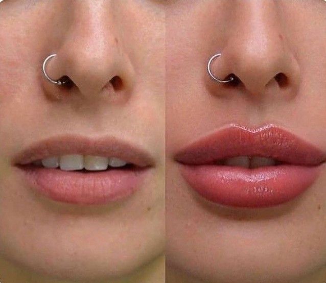 Antes x Depois do preenchimento labial